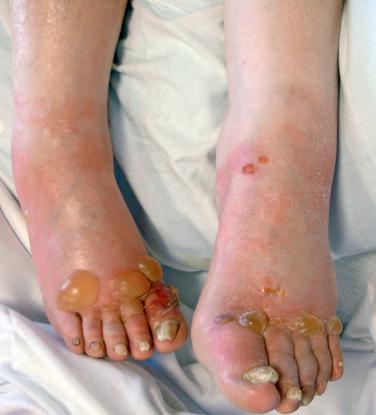 FIGURE 16-4, Tense bullae are representative of bullous pemphigoid.