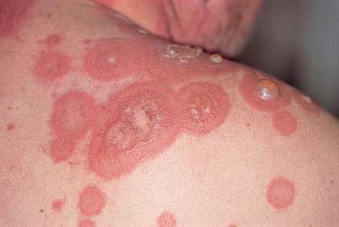 FIGURE 16-5, Multiple tense bullae arising on an urticarial base in a patient with bullous pemphigoid.