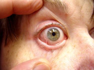 FIGURE 16-6, Scarring ocular disease in a patient with cicatricial pemphigoid.