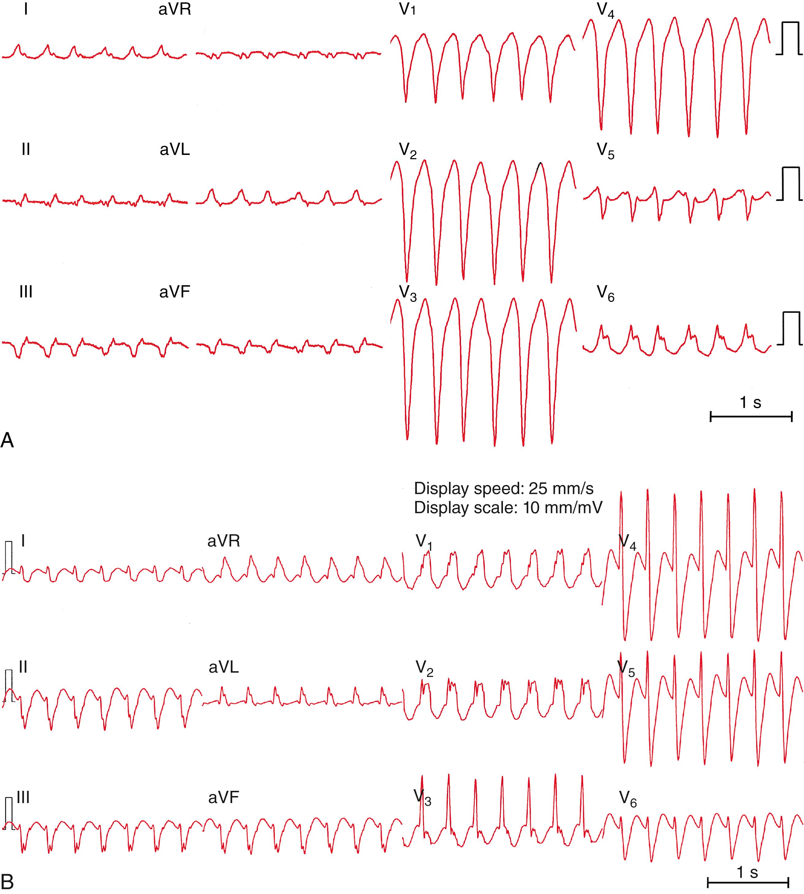 Fig. 84.1, Twelve-lead electrocardiograms (ECGs) during bundle branch reentrant tachycardias.