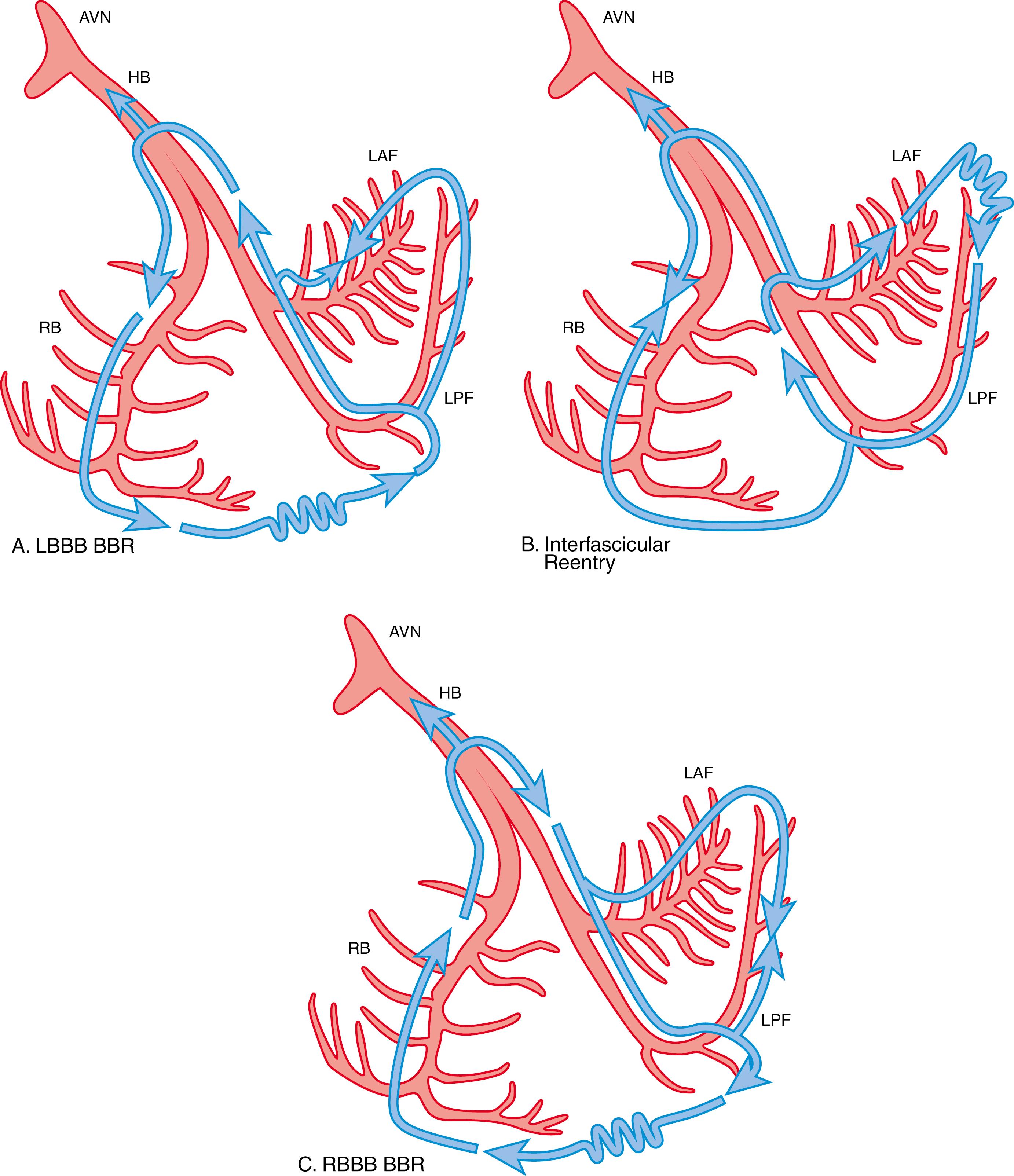 Fig. 84.2, Schematic illustrations of reentrant circuits for BBR and interfascicular reentry.