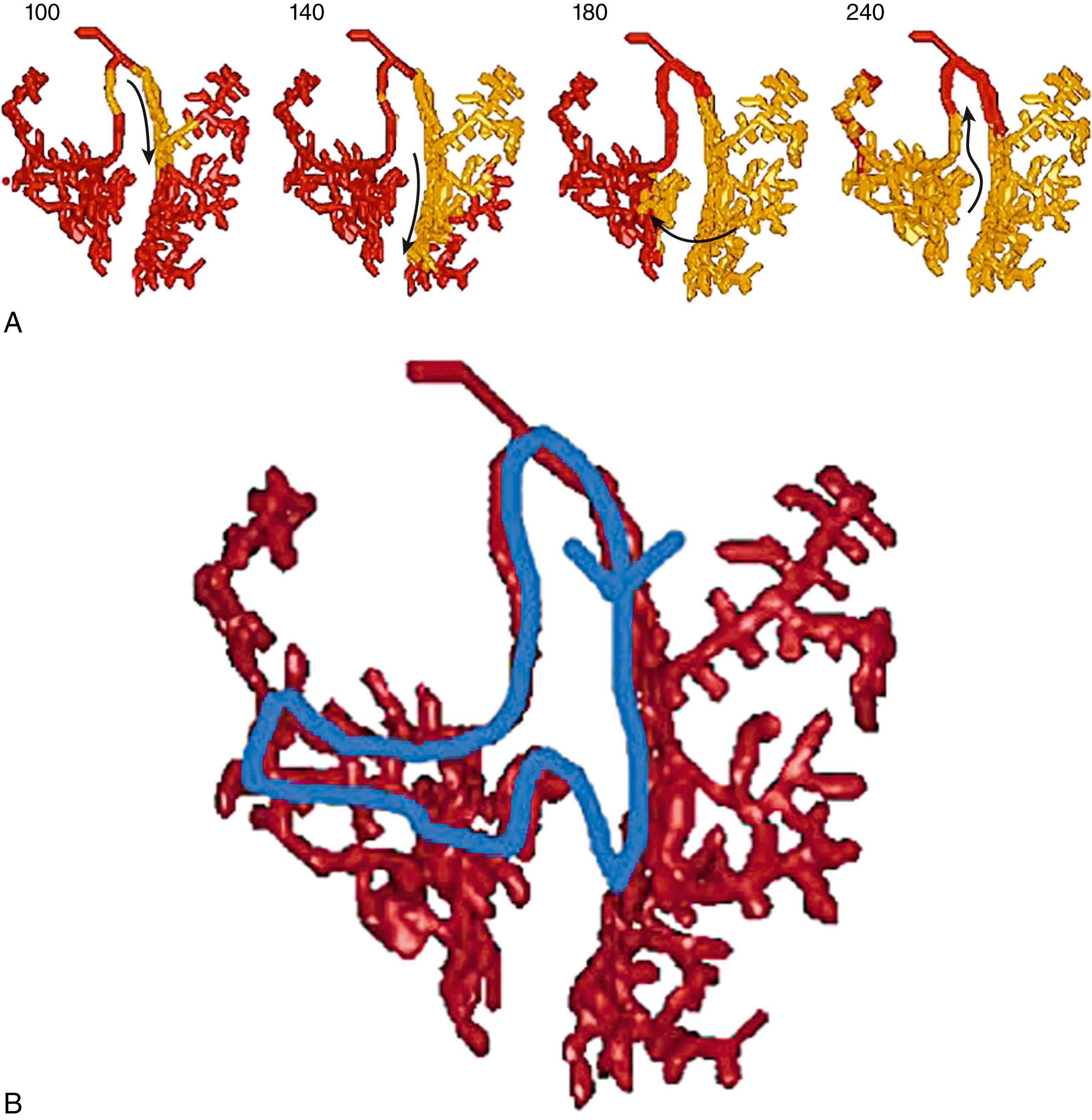 eFig. 84.1, Successful attempt to stimulate bundle branch reentry in a model of ventricular conduction system.