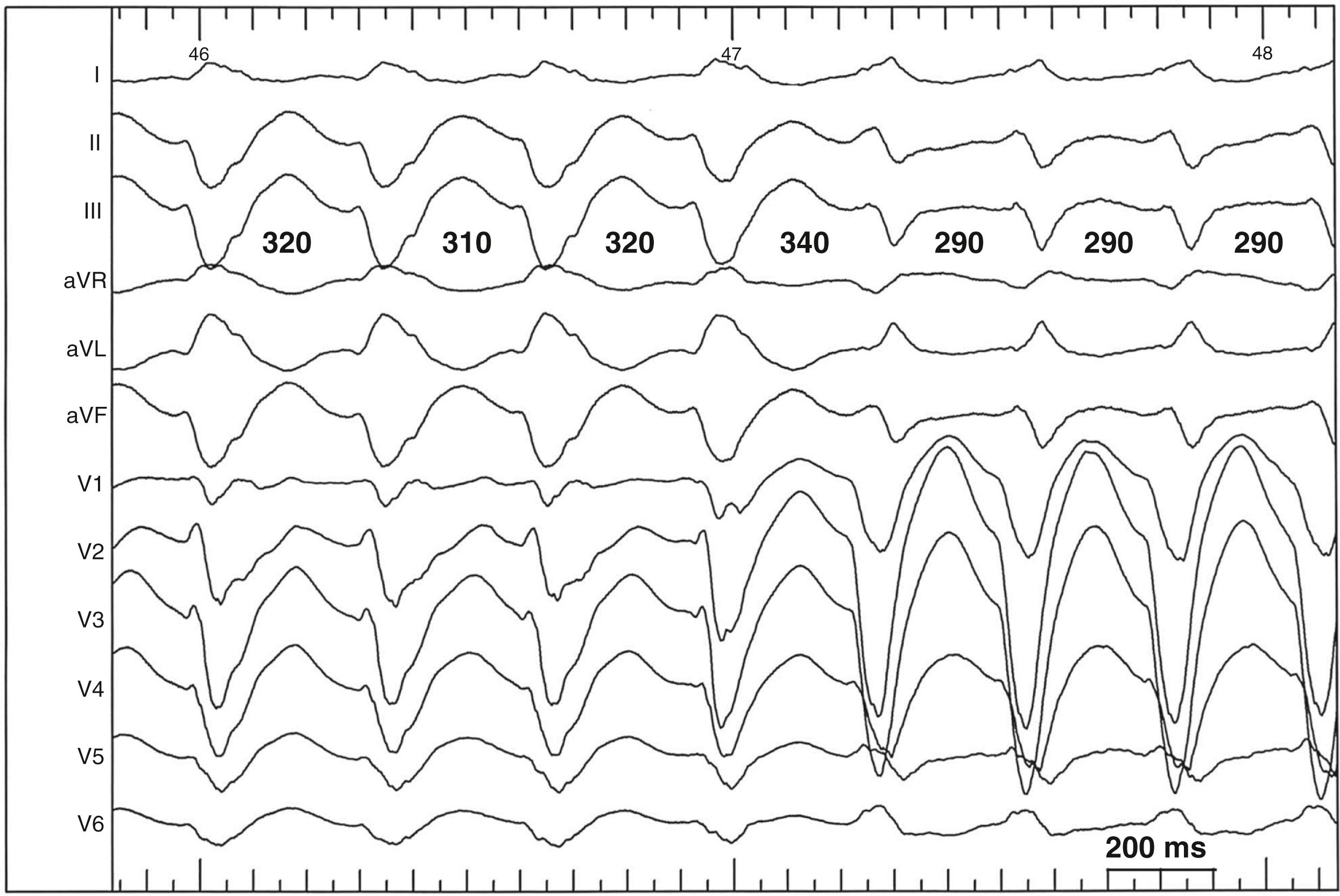 eFig. 84.2, Change from interfascicular ventricular tachycardia (type B) to bundle branch reentry (type A).