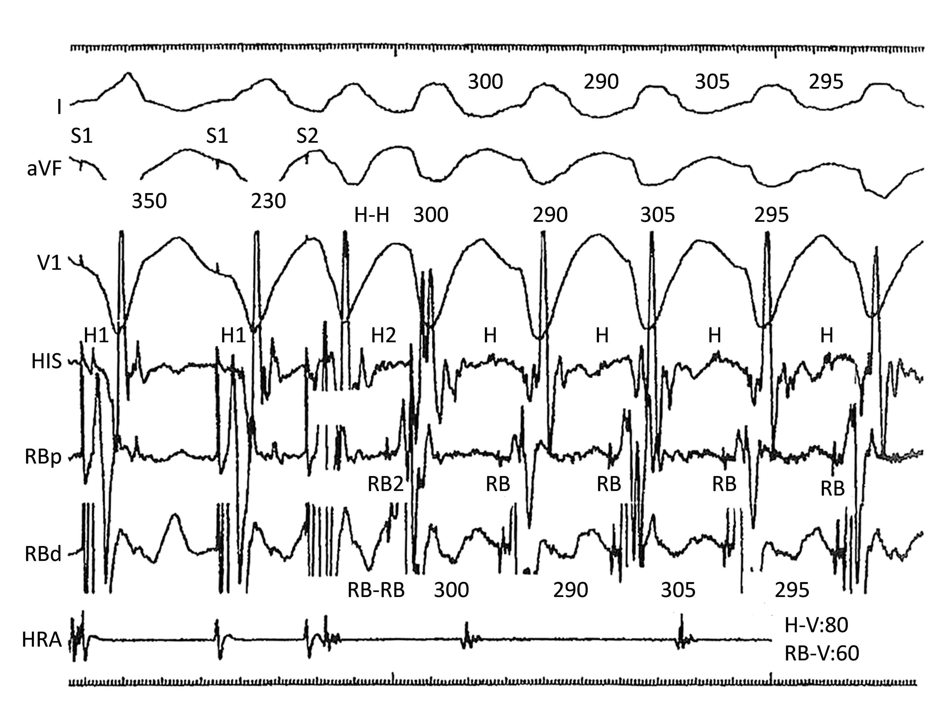 Fig. 84.3, Induction of BBRVT by right ventricular extrastimulus with retrograde slow conduction of left Purkinje system.