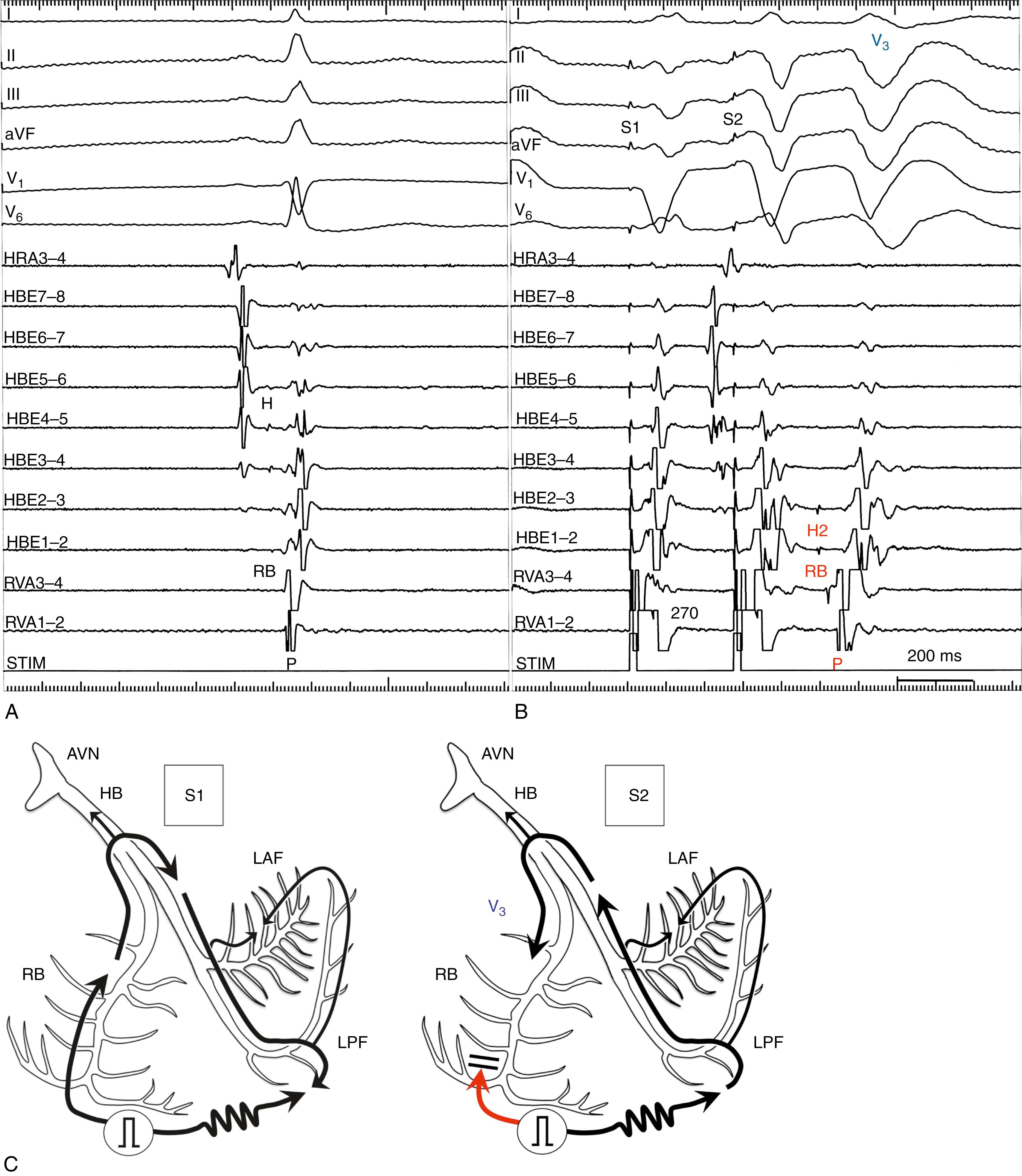 eFig. 84.3, Induction of one bundle branch reentrant beat in a patient with normal His-Purkinje conduction (V3 phenomenon).