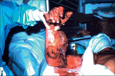 Fig. 5.3, Ufa, Russia, 1989. Invasive Gram-negative burn wound infection may be particularly common after a disaster.