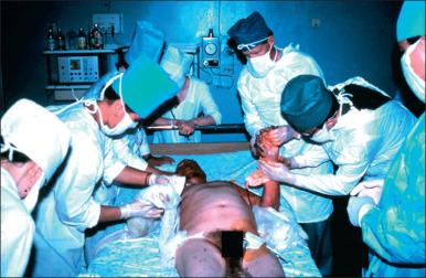 Fig. 5.4, Ufa, Russia, 1989: U.S. and Russian teams perform burn wound care.