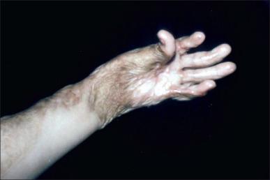 Fig. 47.12, The cupped palm deformity limits the hand's ability to grasp objects normally.