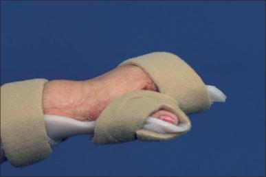 Fig. 47.13, An example of a palmar extension splint to stretch a palmar contracture.