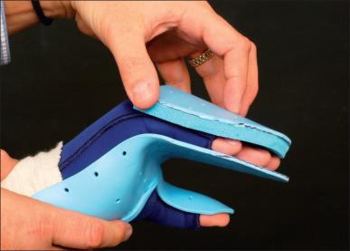 Fig. 47.14, The “sandwich” hand splint prevents proximal interphalangeal (PIP) flexion contractures.