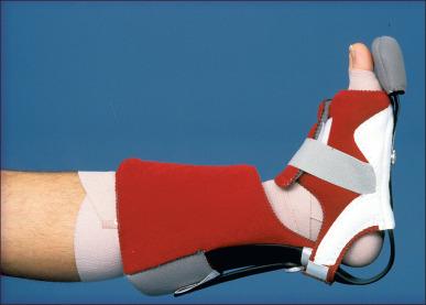 Fig. 47.17, The Multi Podus splint is utilized to position the burned foot appropriately and prevent heel and malleoli skin breakdown.