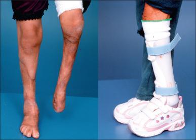 Fig. 47.18, Specialized materials may be required to accommodate anatomical anomalies. Standard ankle–foot orthoses can be fabricated utilizing silicone materials to accommodate excessive scarring and limb loss.