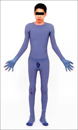 Fig. 47.22, Custom-made pressure garments may be fabricated for the entire body.