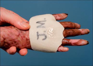 Fig. 47.23, Silicone elastomer inserts for the dorsum of the hand and web spaces are utilized for the prevention of syndactyly and depression in scar tissue.