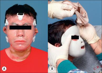 Fig. 47.24, (A) A Uvex clear face mask or (B) a silicon elastomer face mask provides pressure to the face to prevent scar hypertrophy and preserve facial features.