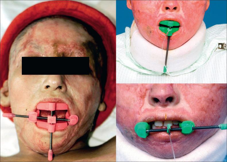 Fig. 47.3, Horizontal, vertical, and circumferential mouth-opening devices are utilized to correct oral microstomia.