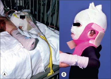 Fig. 47.5, (A) A dynamic head strap mechanism aids in positioning the neck in a neutral position during a prolonged ICU bed confinement. (B) A lateral neck splint is utilized to prevent lateral neck flexion contractures (torticollis).