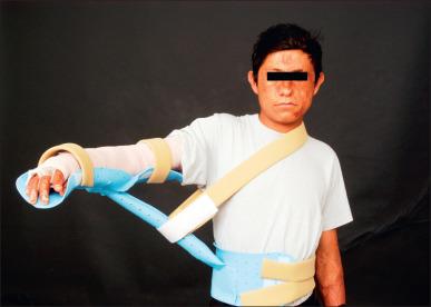 Fig. 47.8, A three-piece airplane splint may be fabricated to accommodate wound dressings and promote healing while maintaining the shoulder abducted.