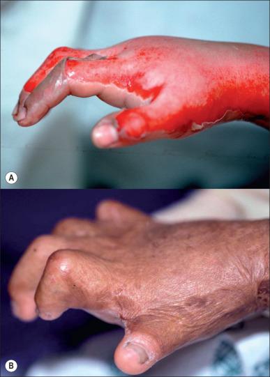 Fig. 47.10, (A) Edema following a full-thickness burn of the dorsum of the hand: imposed metacarpophalangeal extension and interphalangeal flexion. (B) The deformity resulting from the persistence of this position is that of a claw hand.