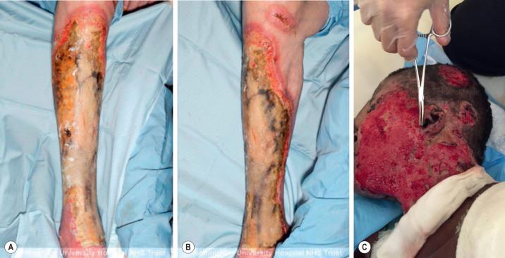 FIG. 4.2.3, (A and B) Full-thickness injury before debridement. (Reproduced from Akhtar N, Abdel-Reh S, Rodrigues J, Brooks P. The use of larvae therapy to debride full thickness burns in the anesthetically unfit patient: the Nottingham experience. Burns . 2011;37(6):e44–e49. Elsevier and ISBI.) (C) Full-thickness injury of the face following debridement.