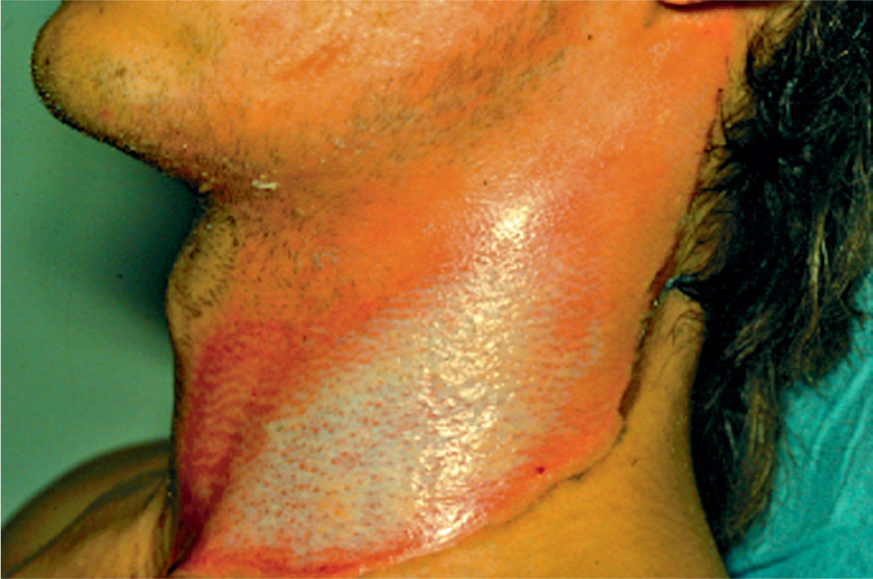 Figure 18.2, Photograph of a gasoline flame burn to the neck and face illustrating the non-uniform heat exposure corresponding to depth of injury from deep partial to epidermal.