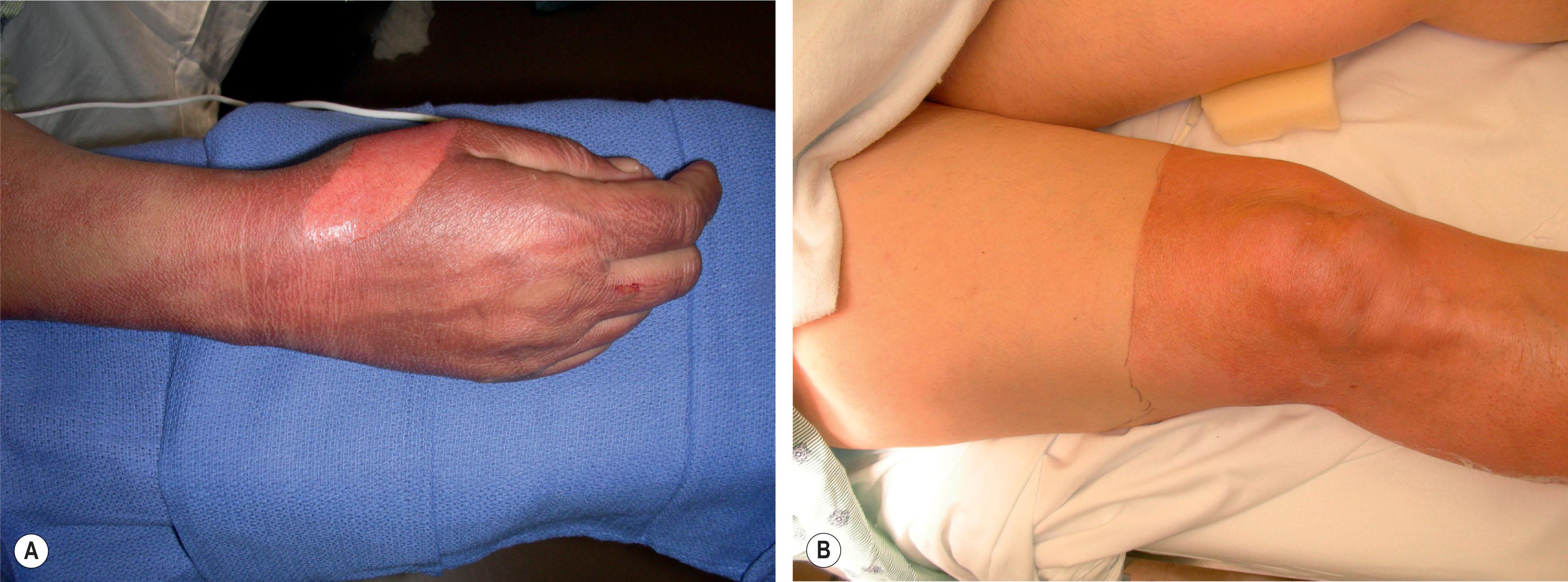 Figure 18.3, Typical appearance of superficial skin burns from (A) low energy electrical arc flash and (B) sunburn.