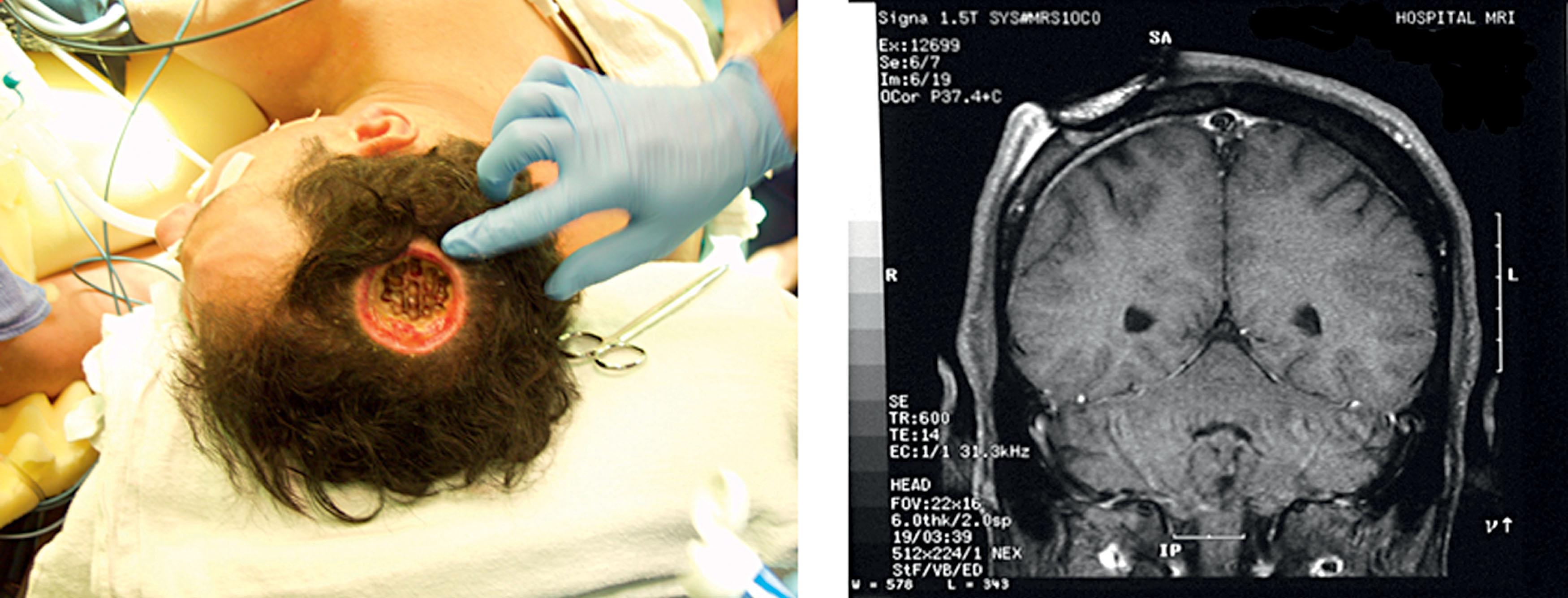 Figure 18.5, MR imaging of an electrical injury to the scalp to visualize the extent of tissue damage and secondary edema formation.