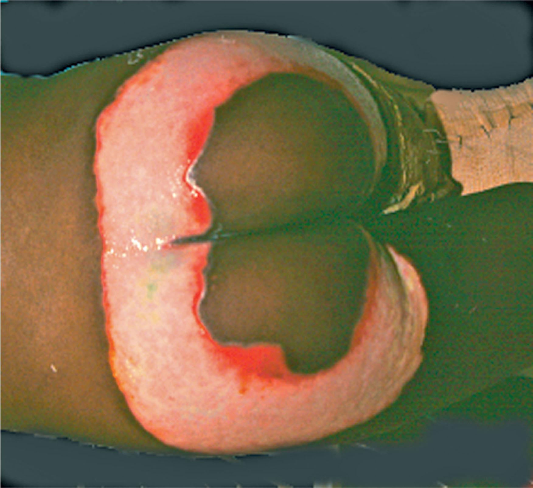 Figure 18.7, The anatomic pattern of injury often provides clues to the cause of injury. The burn tideline is associated with sitting in a bath of hot water. The non-burned area in the center of the ring results from contact with the ceramic in the tub, which is a poor conductor of heat.