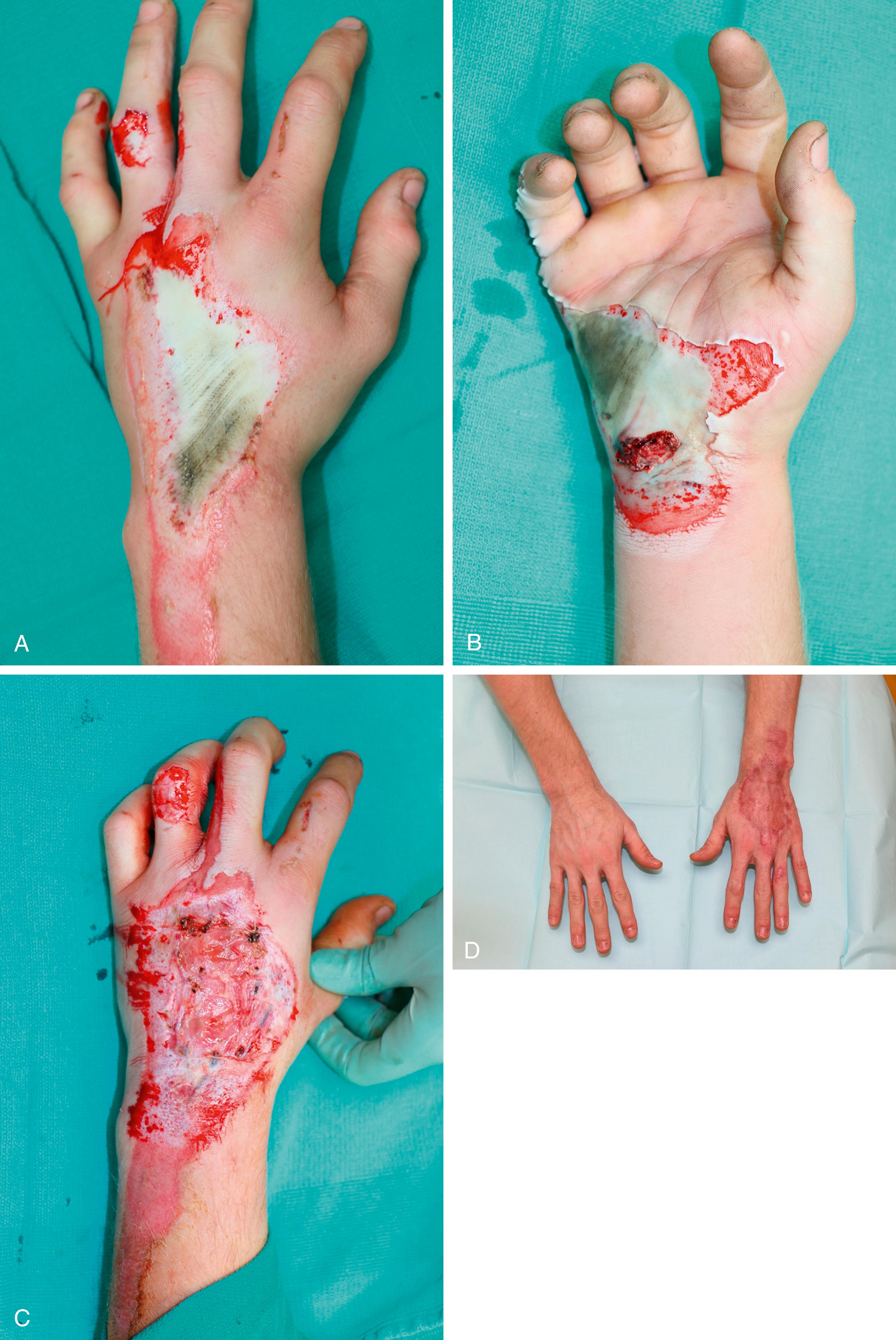 Fig. 13.3, (A,B) Showing full-thickness burns to the volar and dorsal surfaces of the left hand. (C) Debridement and application of primary Integra followed by secondary split-thickness skin graft. (D) Long-term follow up showing healed split-thickness skin graft on the dorsal aspect of the left hand.