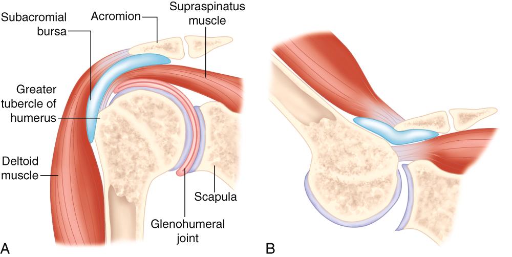 FIGURE 242-1, Relationship of subacromial bursa (shown in blue ) to supraspinatus muscle and acromion process.