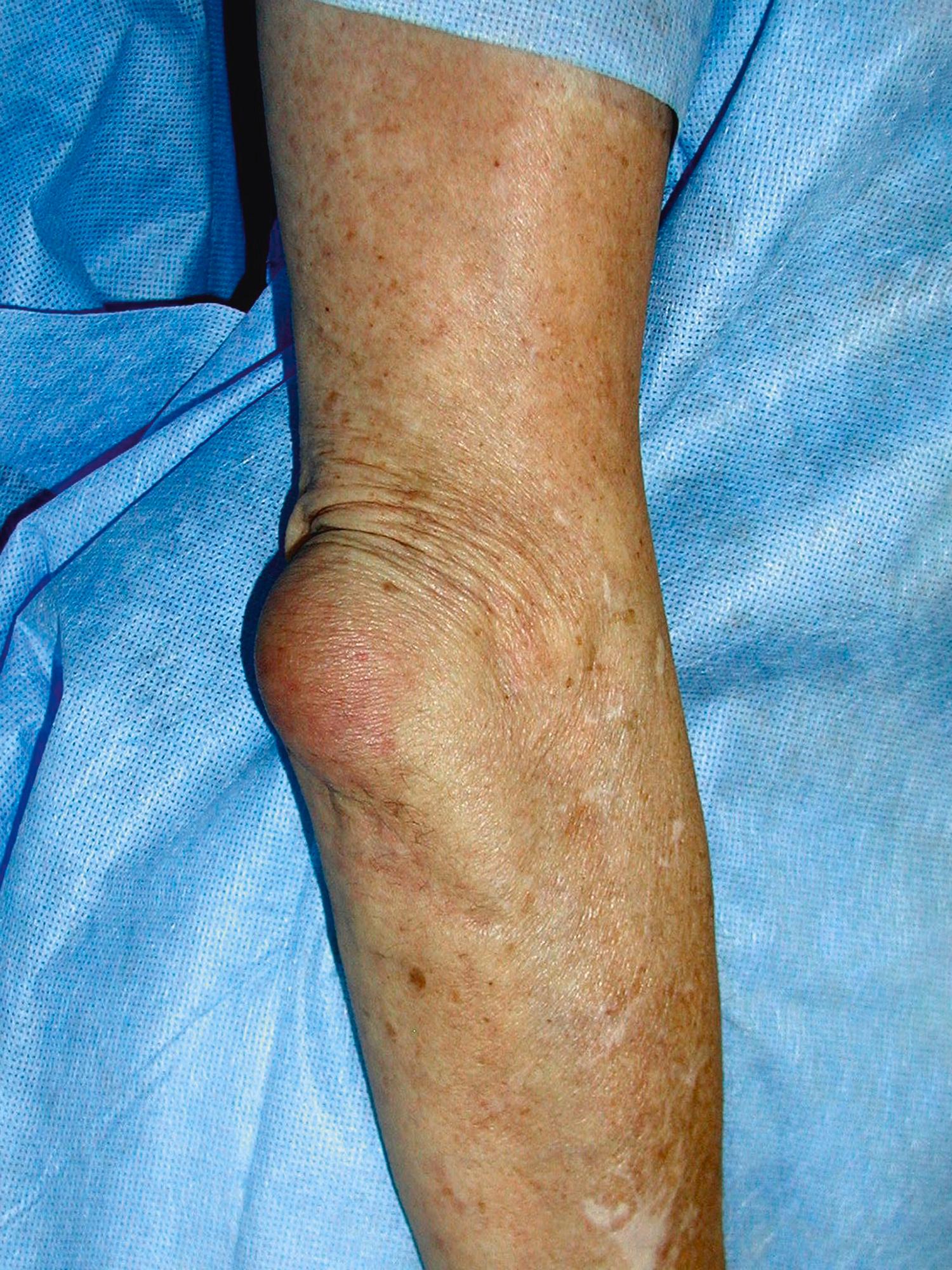 FIGURE 242-4, Olecranon bursitis in an older man. There is swelling at the elbow tip and “inverted U” furrows in the skin proximal to the bursa. For aspiration, the needle should be entered through normal lateral skin, aiming to the geometric center of the bursa to prevent leakage. The aspirated fluid was noninflammatory, sterile on culture, and contained no crystals. In septic bursitis, there may be marked swelling, even suggesting a septic elbow. However, careful passive extension is complete and painless, ruling out septic arthritis.
