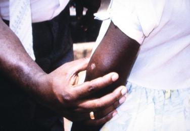 Figure 22-3, Nodular lesion of M. ulcerans disease in a Ghanaian child. Note the incipient ulceration.