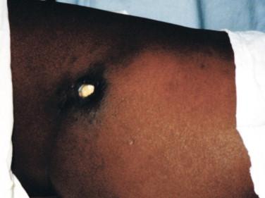 Figure 22-4, Minor ulcer of M. ulcerans disease on upper thigh of young girl from Benin. The ulcer is surrounded by a zone of hyperpigmentation.