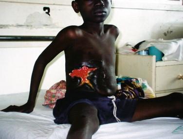 Figure 22-6, Stellate ulcerated lesion in a large indurated plaque of M. ulcerans disease over the abdomen and flank of a Ghanaian boy.