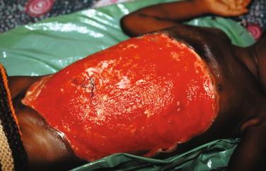 Figure 22-7, Edematous form of M. ulcerans disease, after surgical excision, in a 6-year-old Ghanaian girl. Note the necessary removal of necrotic tissue. There was never any ulceration or indurated plaque.