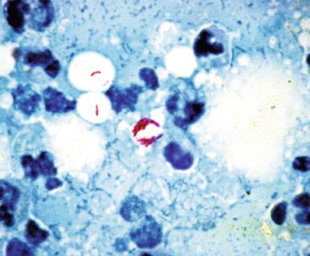 Figure 22-8, Ziehl-Neelsen–stained smear from undermined edge of a major ulcer showing extracellular AFB.