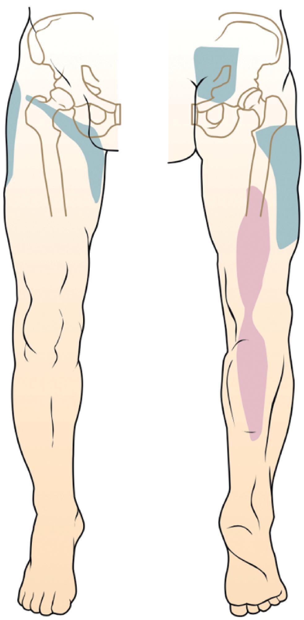 Figure 30.1, Pattern of pain from sacroiliac joint syndrome.