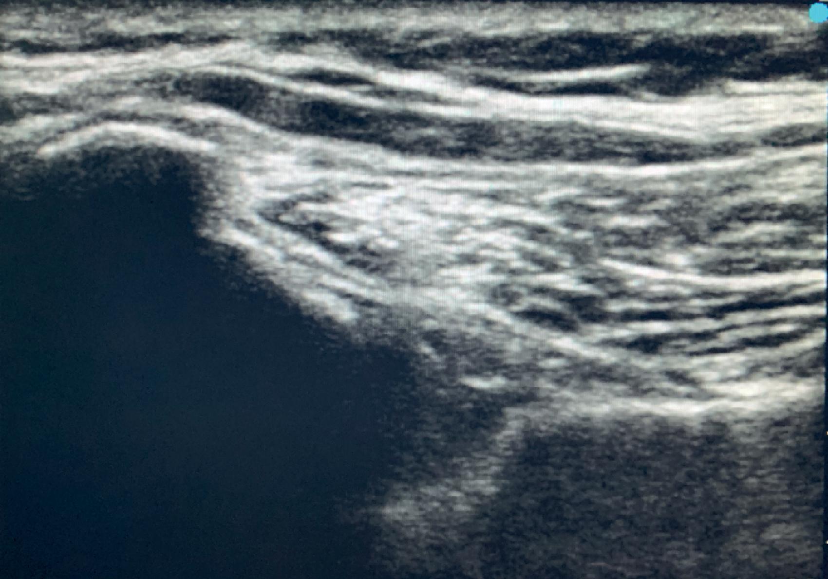 Figure 30.12, Ultrasound visualization of the left SIJ. White arrow , Ideal needle trajectory; SIJ , sacroiliac joint.