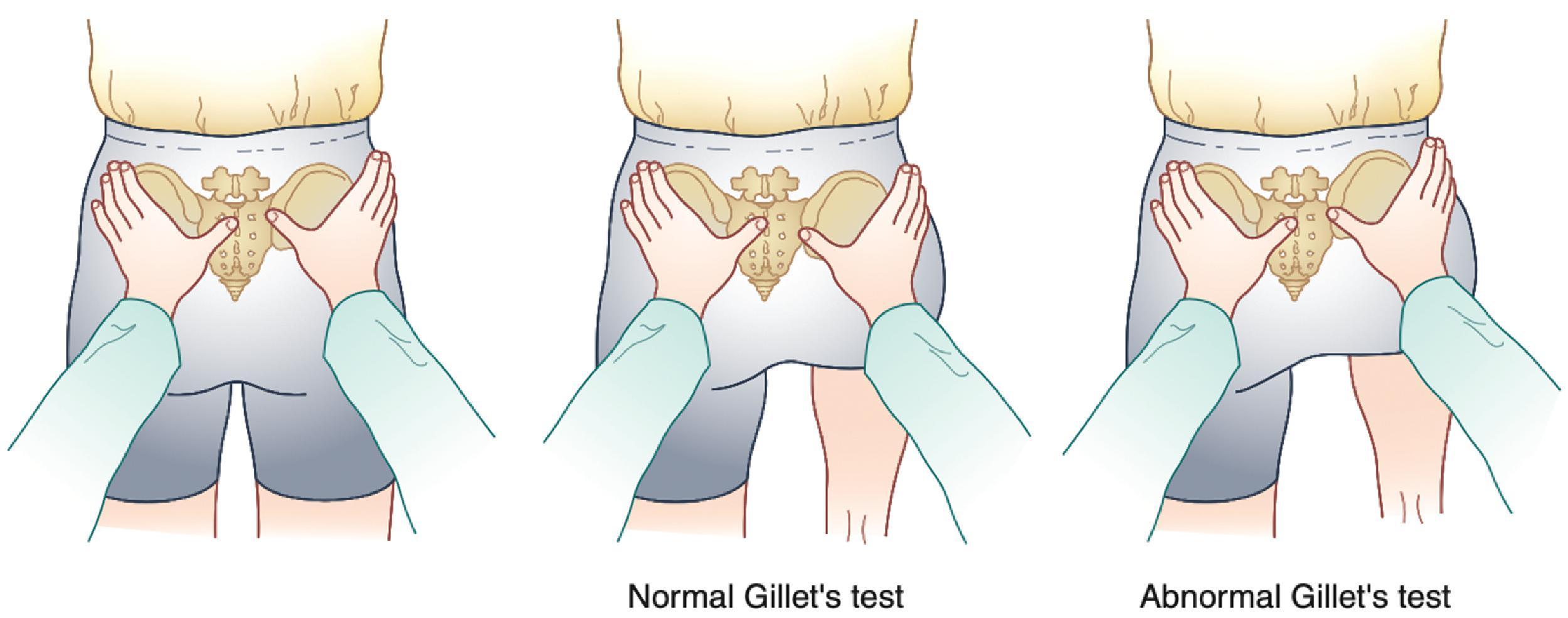 Figure 30.5, Gillet’s test.