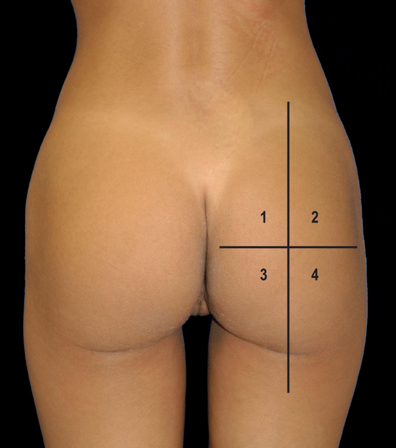 Figure 35.2.2, Ideal gluteal aesthetics based on quadrant analysis.