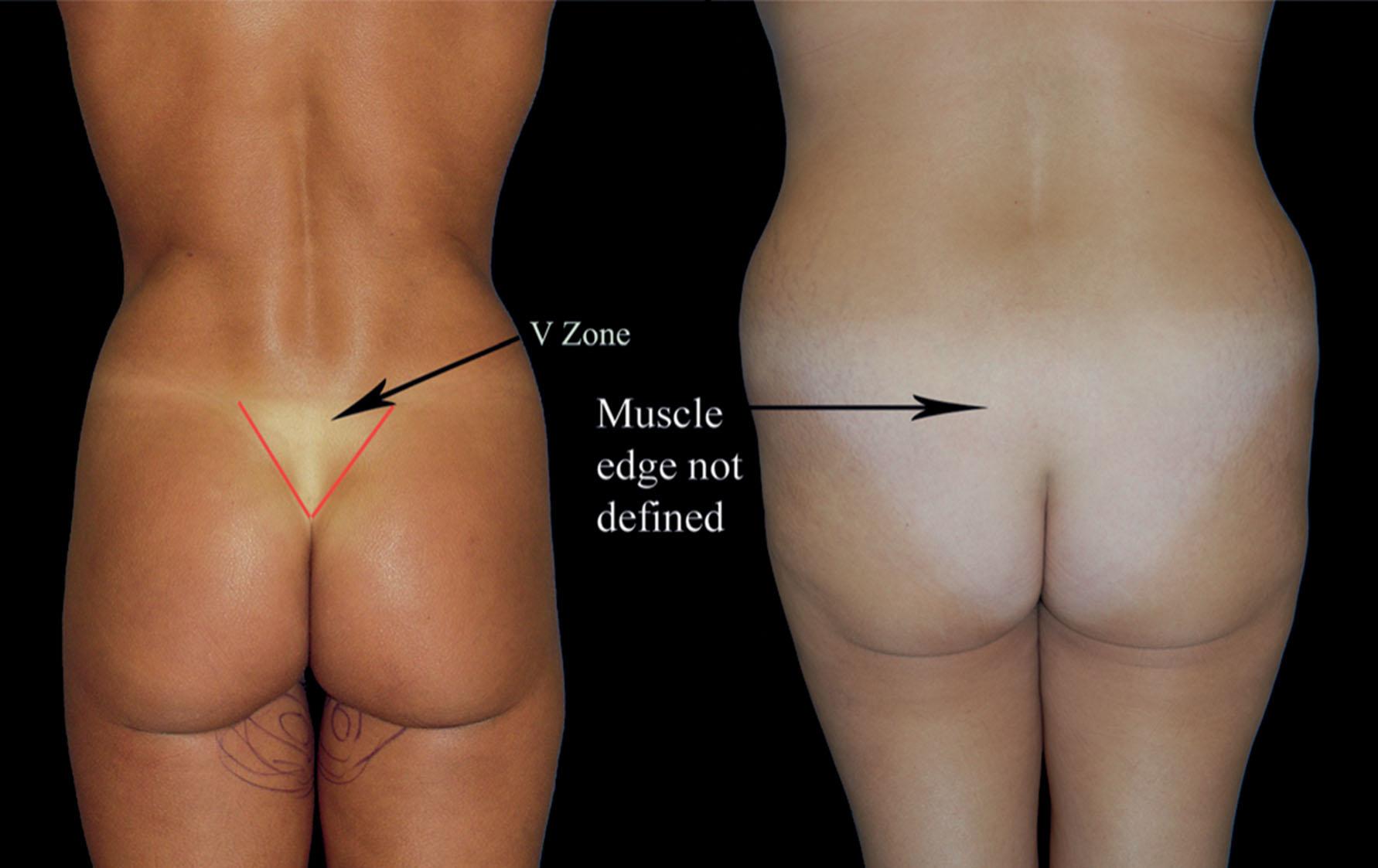 Figure 35.2.3, The “V” zone. Visible muscle fullness vs. loss of definition from excess fat and back of muscle volume.