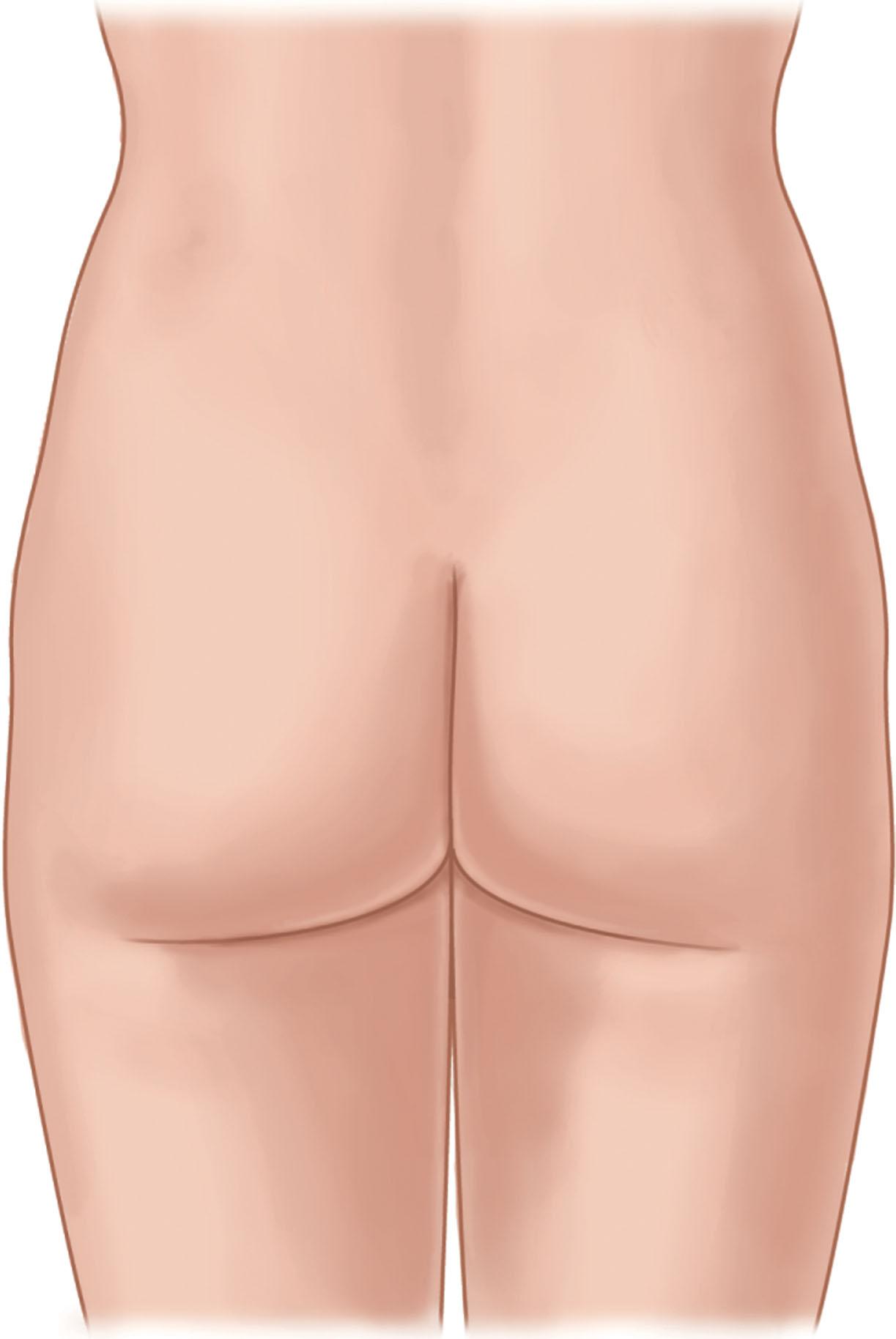 Figure 35.2.8, Ideal gluteal aesthetics. One can see that the upper aesthetic unit of the gluteus follows its origin; it begins at the mid-sacral line, continues as a semicircular line that connects to the posterior iliac spine (identified as bilateral dimples in the parasacral zone), and peaks at 2–3 cm above this point. In a well-developed buttock with very little lower presacral fat, a visible “V” zone is apparent, which further accentuates the upper inner muscle anatomy; the muscle has a football shape with nearly equal volumes in all four quadrants (quadrants three and four tend to be slightly wider than quadrants one and two). The gluteal unit is marked superiorly by its attachment to the iliac ridge (easily palpated) and inferiorly by the inferior gluteal crease. Without a doubt, the most important contributor to gluteal aesthetics is the volume of distribution in all four quadrants. When this volume is adequate, all other aesthetic points can be overlooked and still render an attractive buttock. Inferior gluteal aesthetics are defined by a diamond shape at the intergluteal/leg junction; the medial buttock cheeks have a 45° take-off from the intergluteal line and flow into the inferior gluteal crease, which terminates at or just beyond the mid-buttock line. On lateral view there is an S-shaped curve from the lower back as it comes into contact with the buttock and most of the gluteal volume is located in the central zone.