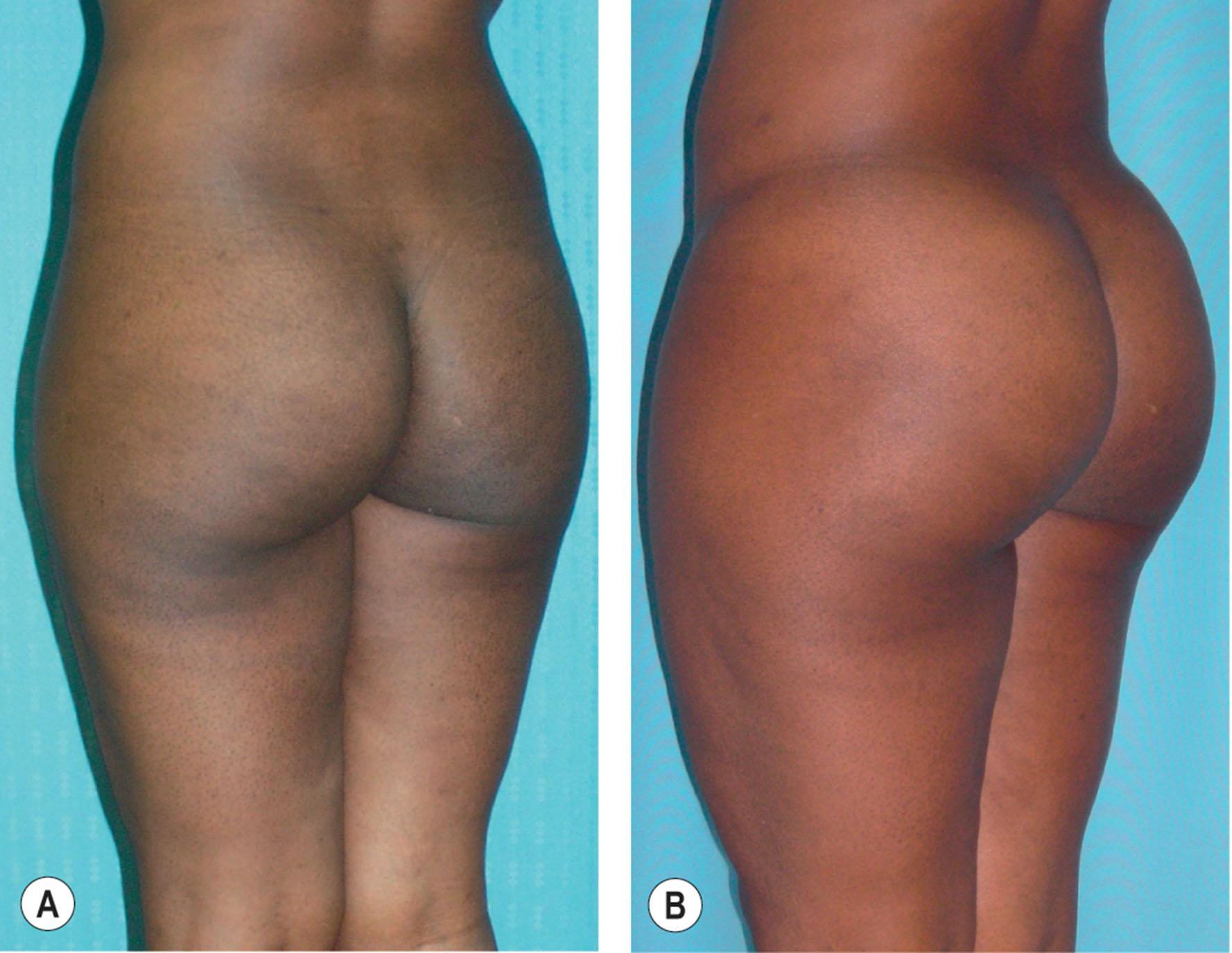 Figure 35.2.9, A 36-year-old African-American female (A) before and (B) after buttocks augmentation with 890 cc of fat grafted per side.