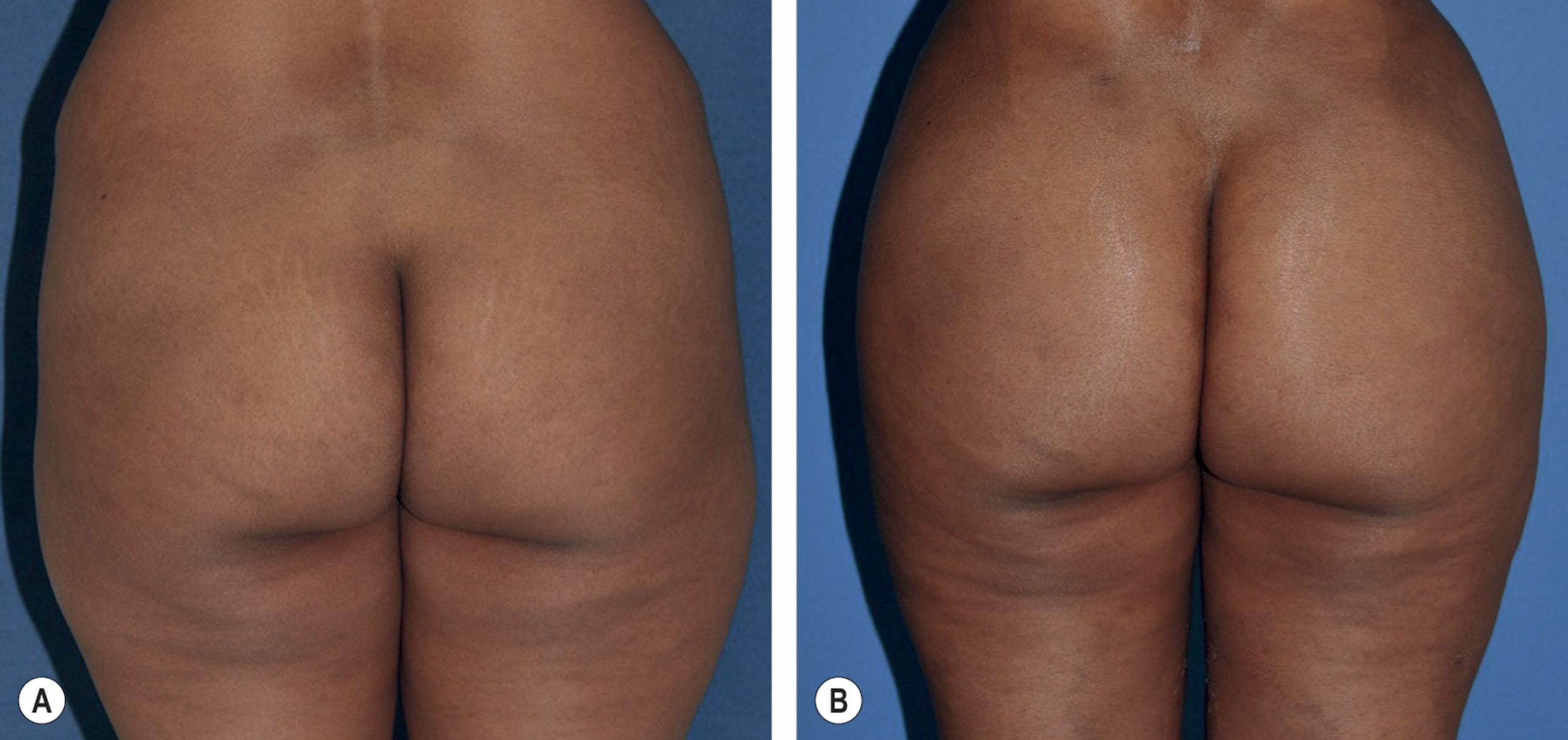 Figure 35.3.1, (A,B) Improvement of the gluteal region with overall volume redistribution.