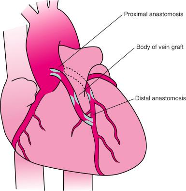 Fig. 27.1, Sites of saphenous vein graft stenoses.