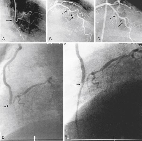 Fig. 27.2, Two cases of failure of minimally invasive coronary artery bypass graft treated with percutaneous catheter-based intervention. Case 1: A 78-year-old woman underwent left internal mammary artery (LIMA) to left anterior descending (LAD) coronary artery surgery through a left fourth intercostal incision without cardiopulmonary bypass because of refractory angina and a long stenosis of a tortuous LAD. Angina at rest recurred within a few hours after surgery, and angiography on the second postoperative day revealed occlusion of the LIMA graft about 4 cm from its insertion into the LAD (A, arrow ). The LAD was tortuous, with multiple, severe stenoses (B, arrows ); left ventricular function was normal. Angioplasty and stent implantation in the native vessel yielded an excellent angiographic result (C, arrows ) and favorable short-term follow-up. Case 2: Because of disabling angina and a long proximal LAD stenosis, a 60-year-old man underwent minimally invasive LIMA to LAD. About 2 hours after surgery, an electrocardiogram showed anterior ST-segment elevation, and emergency coronary arteriography revealed occlusion of the distal LAD at the graft insertion (D, left lateral view, arrow ). Balloon angioplasty through the LIMA graft was successful (E, arrow ), and the patient remained asymptomatic at 6-month follow-up.