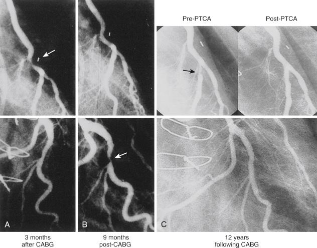 Fig. 27.3, A 37-year-old woman had placement of saphenous vein grafts (SVGs) to the left anterior descending (LAD) and posterior descending coronary arteries. Unstable angina recurred 3 months later, and high-grade stenosis was present at the junction of the SVG to the LAD (A, top: arrow ). The circumflex coronary artery had minimal disease (A, bottom ). The SVG to the posterior descending coronary artery was patent, and balloon angioplasty of the distal anastomosis was successful. Disabling angina recurred 9 months following coronary artery bypass grafting (CABG) . Coronary arteriography (B, top ) showed a widely patent distal anastomosis but high-grade stenosis of the circumflex coronary artery (B, bottom: arrow ) that was unresponsive to nitroglycerin. Balloon angioplasty of the circumflex stenosis was successful (residual stenosis 5%). Twelve years following CABG, angina recurred and recatheterization showed high-grade stenosis of the mid-LAD just beyond the takeoff of a large diagonal (C, top left: arrow ); the vein graft to the posterior descending coronary artery was occluded. Previous percutaneous transluminal coronary angioplasty (PTCA) sites at the distal anastomosis of the vein graft to the LAD and the circumflex artery (C, bottom ) were widely patent. Balloon angioplasty of the mid-LAD was successful. The patient remained asymptomatic for 4.5 years, when a new thrombotic stenosis in the midportion of the SVG to the LAD led to replacement of this graft with a left internal mammary artery graft. All prior PTCA sites were patent, and surgical benefit was extended over 16 years with three percutaneous procedures.