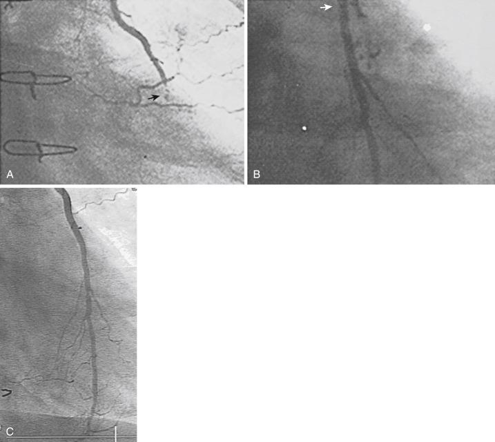 Fig. 27.4, A 52-year-old man experienced recurrence of angina 5 months after a triple coronary bypass. Coronary arteriography revealed total occlusion of the left internal mammary artery (LIMA) 1 to 2 cm proximal to insertion into the left anterior descending (LAD) coronary artery (A, arrow ), severe stenosis of a large diagonal, and patent grafts to the obtuse marginal and right coronary arteries. The LIMA was recanalized by use of an 8-Fr internal mammary artery guide catheter for good backup, progression to a relatively stiff guidewire to punch across the total occlusion, and a 2-mm over-the-wire balloon (result after percutaneous transluminal coronary angioplasty: B, arrow ). The diagonal was successfully dilated. The patient presented again 5 years later with recurrent angina and was found to have an occluded saphenous vein graft to the obtuse marginal artery; the native obtuse marginal artery was successfully dilated. The LIMA-to-LAD anastomosis was widely patent (C), as was the diagonal, 5 years after recanalization.