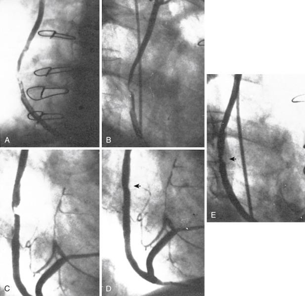 Fig. 27.6, A 59-year-old man developed recurrent rest pain 10 years after coronary bypass surgery. (A) Coronary arteriography revealed high-grade stenosis with thrombus and poor flow in a sequential saphenous vein graft (SVG) to the posterior descending and circumflex coronary arteries. No narrowing was present in the left anterior descending coronary artery, diagonal, and large anterior marginal systems. The inferior left ventricular wall was moderately hypokinetic. (B) After infusion of thrombolytic agent into the graft for approximately 1 hour, flow improved and thrombus was diminished. The patient was maintained on intravenous heparin for several days. (C) Coronary arteriography then showed that an eccentric, high-grade focal stenosis was present in the proximal SVG to the right coronary artery without thrombus. (D) After placement of a 4.0-mm stent (arrow) , the patient became asymptomatic. (E) Recatheterization 6 months later revealed excellent patency of the SVG with mild narrowing of approximately 40% at the stent site (arrow) . At last follow-up, the patient remained asymptomatic. The availability of thrombectomy and embolic protection make a more direct approach with thrombectomy appealing in some patients with extensive SVG thrombus.