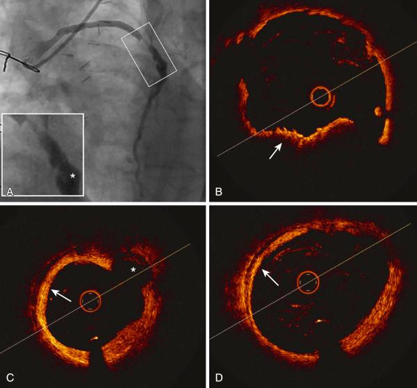 Fig. 27.7, Angiography and optical coherence tomography (OCT) of a saphenous vein graft (SVG) lesion in a patient with non–ST-segment elevation myocardial infarction. (A) Angiography of an SVG to left anterior descending coronary artery with severe narrowing and thrombus (white box) . Plaque ulceration with a flap is shown in the magnification (∗). (B) OCT at the site of the lesion reveals red thrombus (arrow) . (C) Intimal rupture with a large cavity underneath (∗) is also apparent. In (C) and (D), arrows point to a signal-rich layer, under which a signal-free layer is evident that separates the former from the SVG wall. In all OCT frames, fibrofatty composition of the intima is evident.